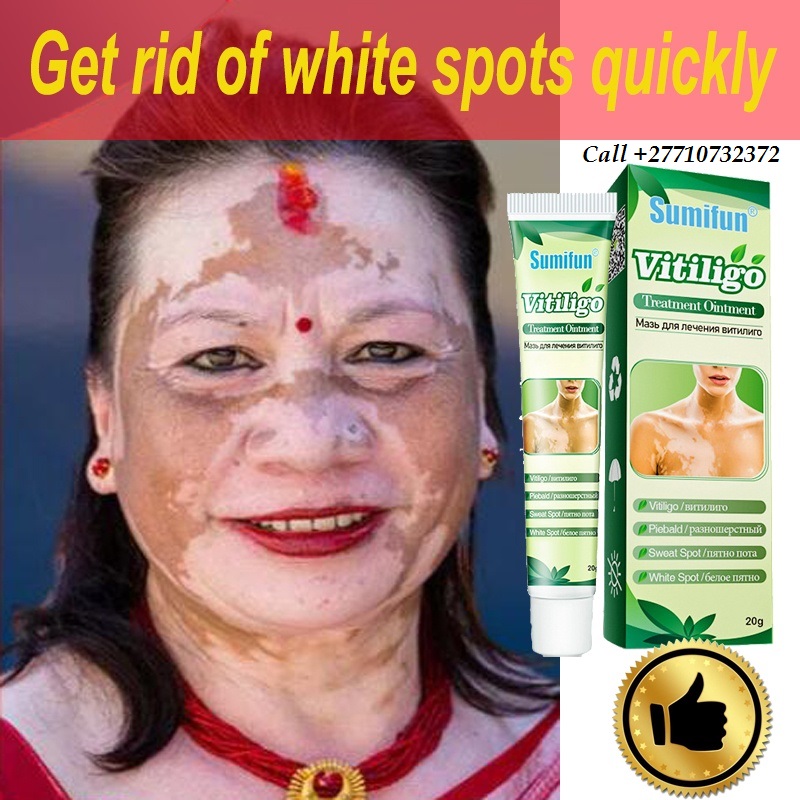 Get Rid Of Vitiligo In Puñal City In Dominican Republic And Vaasa City In Finland Call +27710732372 Scars And Stretch Marks In Twin Oaks City in Missouri And Vereeniging City In South Africa